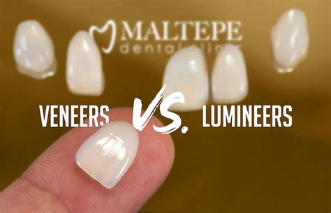 veneer or lumineer.